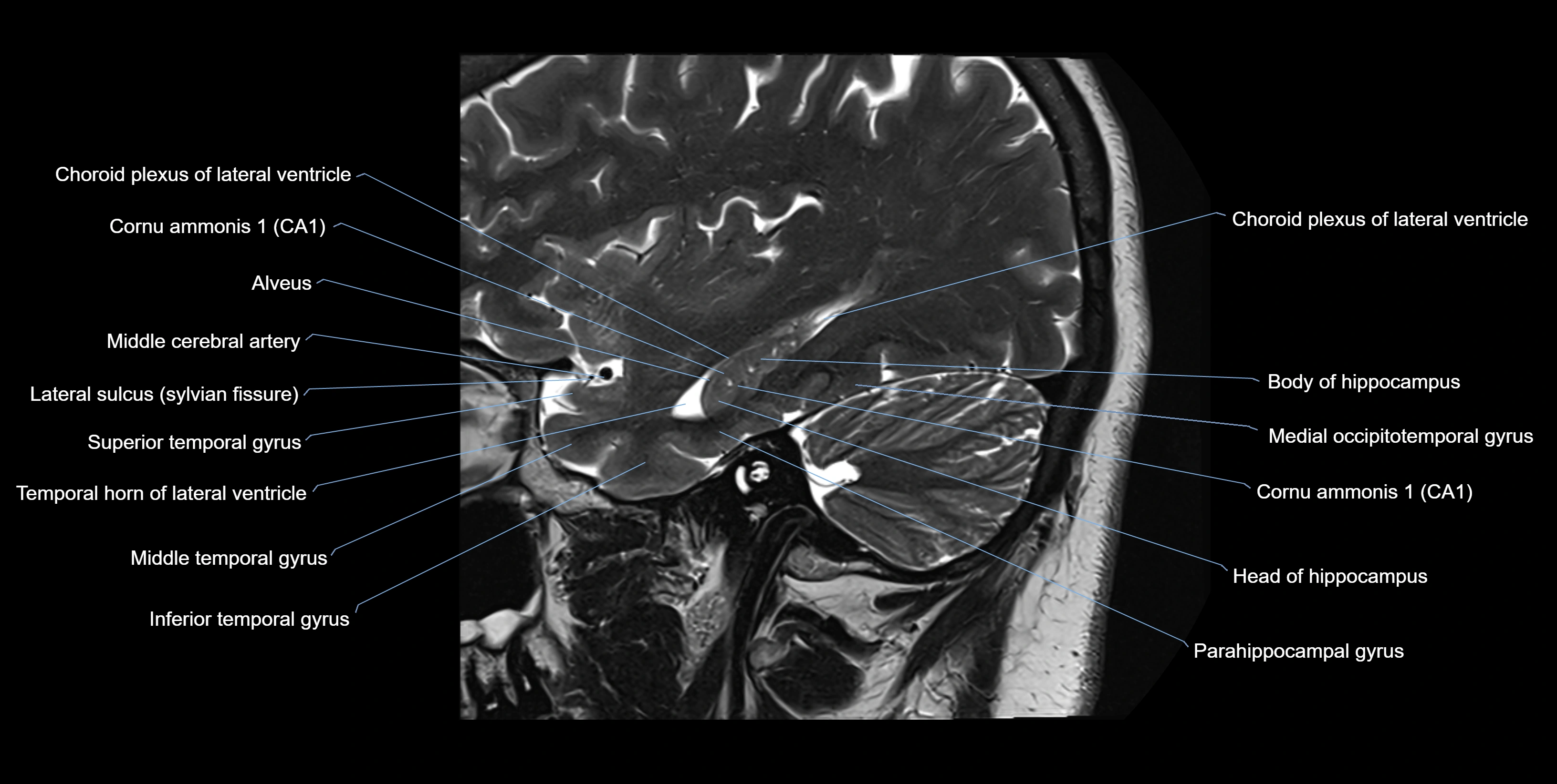 hippocampus sagittal cross sectional anatomy 3T MRI images -img-10003.webp